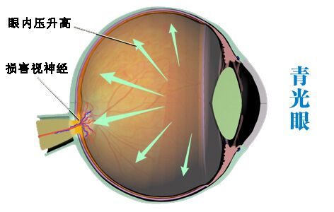 青光眼手術(shù)為什么可能加速白內(nèi)障的形成