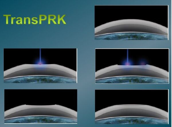 TransPRK手術與蔡司全飛秒手術、半飛秒手術有什么區(qū)別?