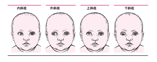 蘭州兒童眼病專家：孩子常常歪脖子可能是斜視