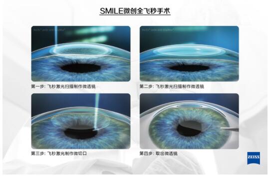 【微雕全飛秒】近視眼手術(shù)已經(jīng)進入小創(chuàng)傷無瓣新時代