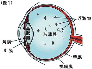 眼前有黑點(diǎn)飄，視物有些變形是什么眼病